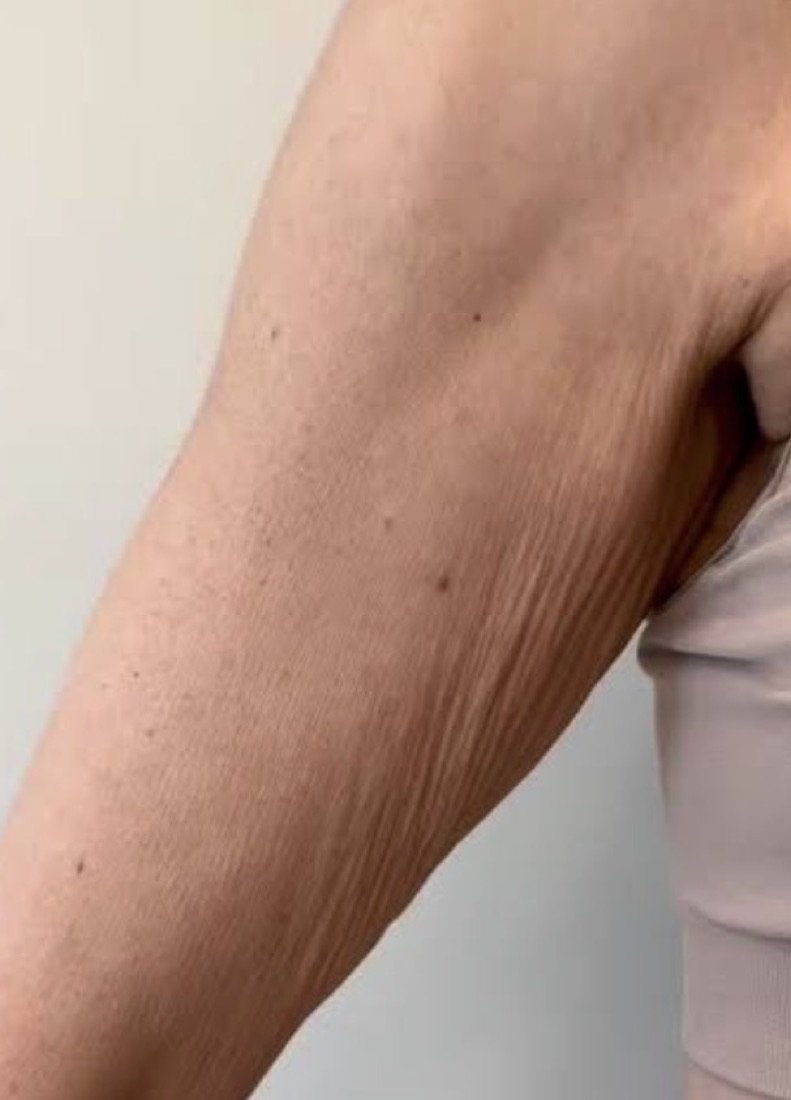 Braço com flacidez leve na face interna